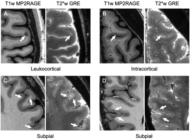 Cortical Lesions