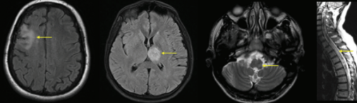 Neurobehcet